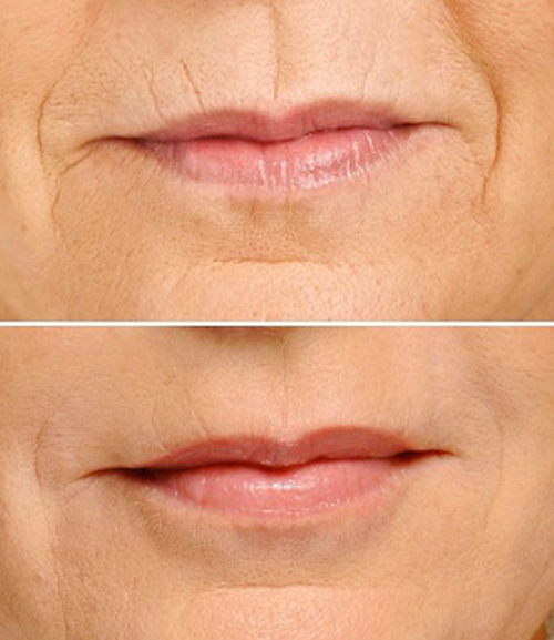 dermalfillers Colac Dental Practice